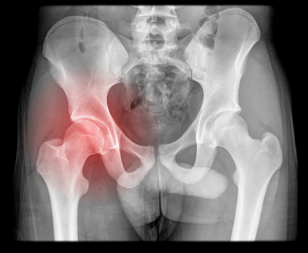 xray of hip pain